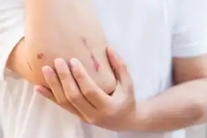 BPC-157 and TB-500 Blend